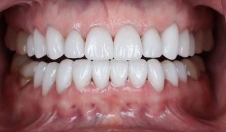 Stunning Smiles | Invisalign®, All-on-6® Dental Implants and Cosmetic Dentistry