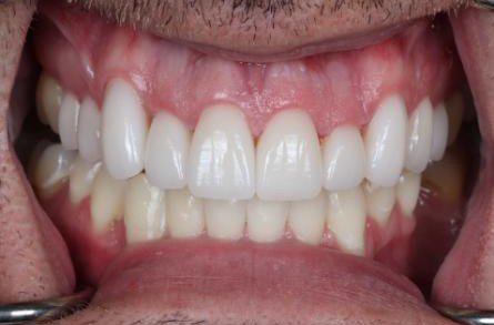 Stunning Smiles | Emergency Dentistry, Same-Day Dental Crowns and Preventive Dentistry