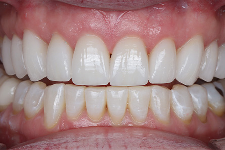 Stunning Smiles | Cosmetic Dentistry, Same-Day Dental Crowns and All-on-6 reg  Dental Implants