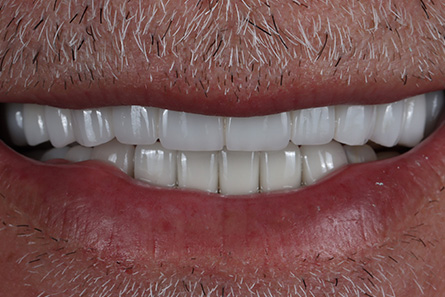 Stunning Smiles | Invisalign reg , Same-Day Dental Crowns and All-on-6 reg  Dental Implants