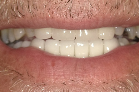 Stunning Smiles | Same-Day Dental Crowns, Teeth Whitening and Restorative Dentistry