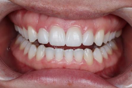 Stunning Smiles | Invisalign®, All-on-6® Dental Implants and Periodontal Treatment