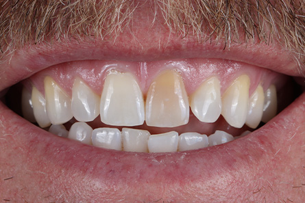 Stunning Smiles | Teeth Whitening, Dental Implants and All-on-6 reg  Dental Implants