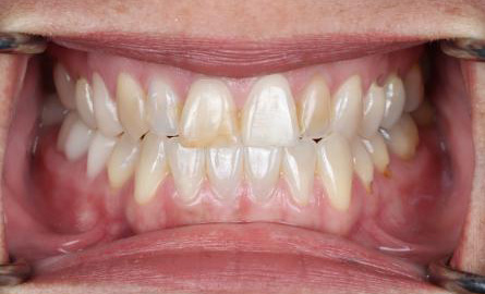 Stunning Smiles | Restorative Dentistry, Teeth Whitening and Dental Implants