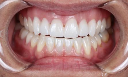 Stunning Smiles | Dental Implants, Emergency Dentistry and Same-Day Dental Crowns
