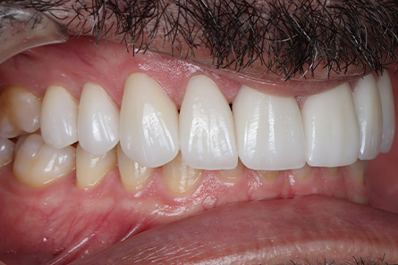 Stunning Smiles | Same-Day Dental Crowns, Emergency Dentistry and Dental Exams