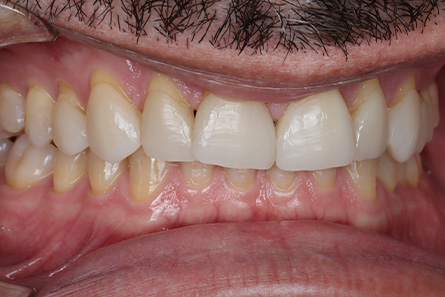 Stunning Smiles | Same-Day Dental Crowns, All-on-6® Dental Implants and Cosmetic Dentistry