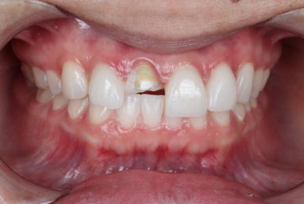 Stunning Smiles | All-on-6® Dental Implants, Cosmetic Dentistry and Same-Day Dental Crowns