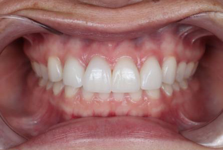 Stunning Smiles | All-on-6® Dental Implants, Emergency Dentistry and Smile Makeovers