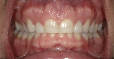 Stunning Smiles | All-on-6® Dental Implants, Same-Day Dental Crowns and Dental Implants