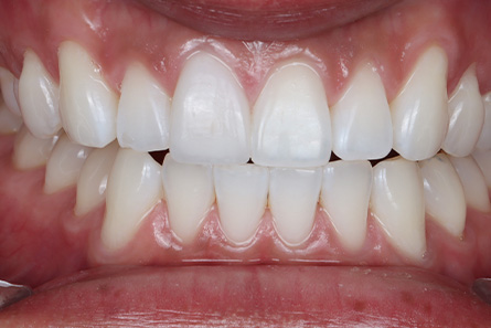 Stunning Smiles | Teeth Whitening, Dental Implants and Same-Day Dental Crowns