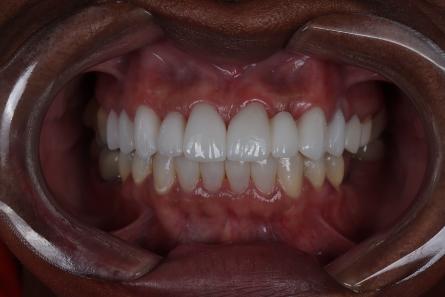 Stunning Smiles | Same-Day Dental Crowns, Periodontal Treatment and Smile Makeovers