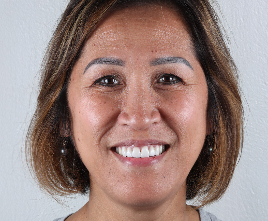 Stunning Smiles | All-on-6 reg  Dental Implants, Restorative Dentistry and Dental Implants